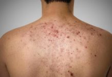 Черные точки на теле