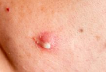 3 стадии угревой сыпи