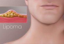 Липома: что это такое, причины происхождения, симптоматика, методы терапии |