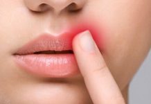 Чем лечить заеды в уголках рта: ТОП 5 мазей для лечения в домашних условиях