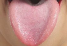 Почему могут появляться высыпания на детском язычке: симтомы, виды сыпи, что делать