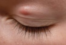 Можно ли удалить жировик в домашних условиях на веке или на лице? Отзывы