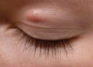 Можно ли удалить жировик в домашних условиях на веке или на лице? Отзывы