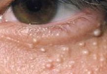 Как избавиться от жировиков на лице в домашних условиях: лучшие рецепты