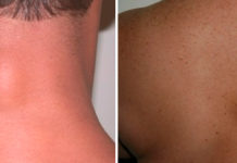 Разновидности и строение подкожных жировиков | Блог мамы-врача