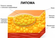 Жировики на теле
