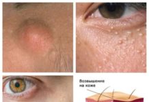 Жировики на веках глаз