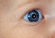 Жировики у новорожденных (на лице, на носу), лечение у грудничков