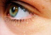 Как удалить жировик на лице — рецепты домашнего использования