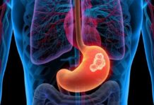 Рак желудка Рак желудка