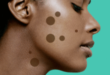 Где и как удалить родинку без боли и страха: лучшие методы на PEOPLETALK