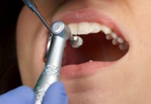 Стоит ли делать профессиональную чистку зубов?