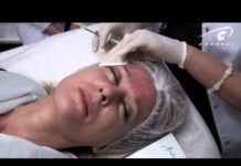 Папулы после биоревитализации * Фото, сколько дней держаться и почему, когда проходят и рассасываются