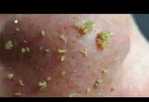 Как избавиться от прыщей на лице – самые эффективные средства, их виды