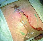 ВЕТРЯНАЯ ОСПА | #01/04 | «Лечащий врач» – профессиональное медицинское издание для врачей. Научные статьи.