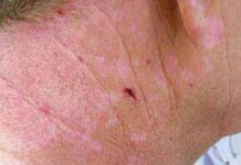 Симптомы кожных заболеваний (кожные высыпания) — Для пациентов — Внутренняя Mедицина