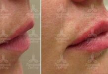 Увеличение губ: ответы врача на популярные вопросы / Лазерный Доктор СПб