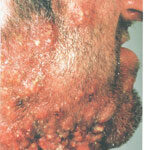 Принципы диагностики и лечения хронического рецидивирующего фурункулеза | #06/05 | «Лечащий врач» – профессиональное медицинское издание для врачей. Научные статьи.