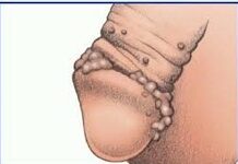 Что такое «Язвы на половом члене: причины появления и основные направления лечения» — глоссарий портала