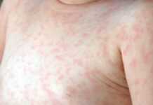 Как Долго Заразна Розеола У Детей