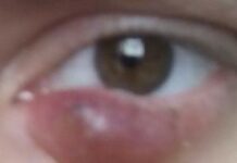 Ячмень на левом или правом глазу — примета, магия, от чего появляется