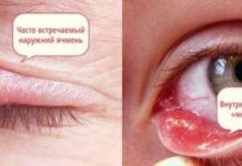 Как выглядит ячмень на глазу — фото по стадиям — ОНЛАЙН БОЛЬНИЦА