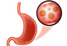 Полипы желудка: операция по удалению, эндоскопическое лечение и диагностика полипов желудка