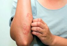 Что такое экзема