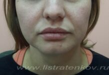 Комки Биша — фото до и после операции, отзывы пациентов