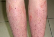 Дерматит на ногах: причины и лечение.
