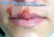 Профилактика ВИЧ-инфекции. Простой герпес