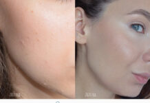 Как уход с кислотами навсегда избавил меня от комедонов? | Отзывы покупателей | Косметиста