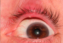 Что будет, если выдавить ячмень на глазу и почему врачи категорически не рекомендуют это делать
