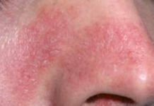 Шелушение кожи на носу и вокруг него, причины и лечение