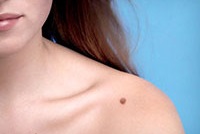 Наросты на коже. Описание и фото новообразований.