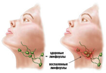 Лимфоузлы при сифилисе: опытный венеролог в Москве.