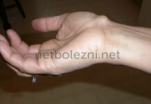 Твердая шишка на запястье, на руке сверху