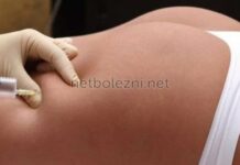 Что делать если после уколов в ягодицу образовалось уплотнение