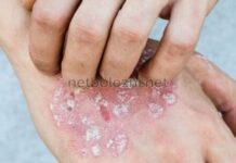 Экзема на руках и ногах: мази для лечения, отзывы о препаратах