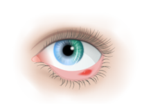 Лечение ячменя