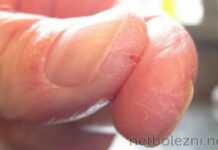 Шелушится, сохнет и трескается кожа рук, какие витамины нужно пить