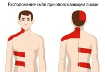 Опоясывающий лишай или герпес: симптомы и лечение