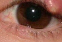 Ячмень на глазу: как избавиться от ячменя на глазу: 10 простых домашних средств — ячмень, глаза, народные средства, лечение