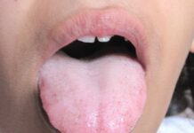 Заболевания языка: симптомы, виды, методы лечения и профилактика