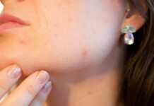Лечение прыщей на лице у женщин и мужчин в современной косметологии