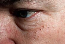 Как избавиться от закрытых и открытых комедонов на лице: причины появления, косметологические процедуры, аптечные препараты, домашние средства