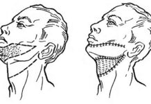 Аутодермопластика: симптомы, методы лечения, рекомендации. Консультация специалистов.