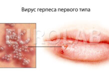 Герпес при беременности — Медицинский портал EUROLAB