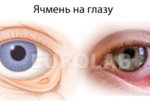 Как лечить ячмень? Медицинский портал EUROLAB