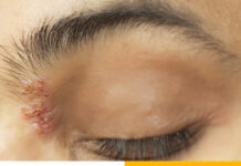 Герпес на глазу: симптомы и лечение – НаПоправку – НаПоправку